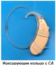 кольцо фиксирующее для слухового аппарата