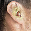 Внутриушные слуховые аппараты.  Важные нюансы выбора